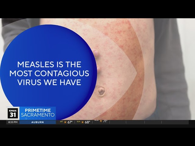 The Answer: What to know with recent measles outbreaks?