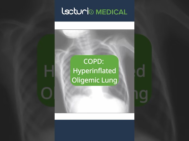 📸 X-Ray Insights: Hyperinflated Lungs! #Radiology #LungHealth #usmle