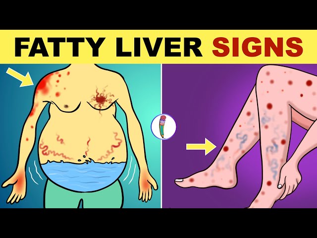 Fatty Liver Symptoms | Early Signs of Fatty Liver Disease | Non Alcoholic Fatty Liver Disease