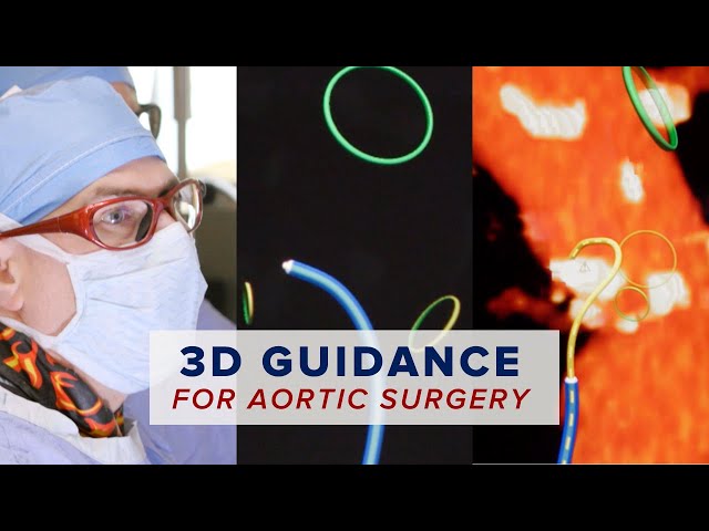 Pioneering New 3D Guidance for Aortic Surgery: Fiber Optic RealShape (FORS) Technology