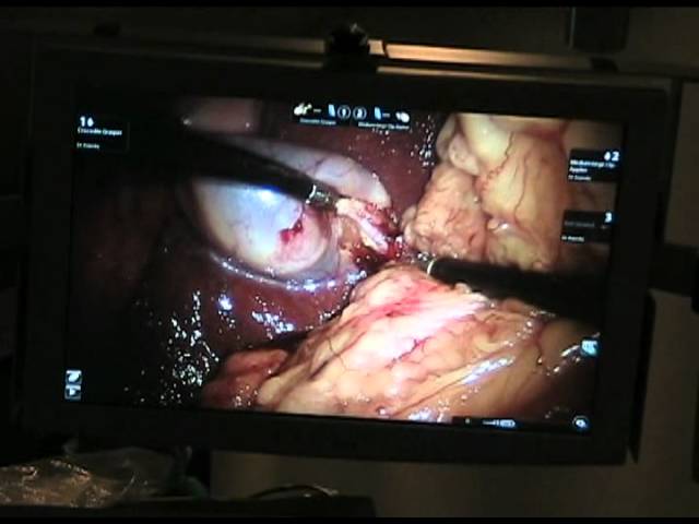 Single-site robotic gallbladder surgery full length video
