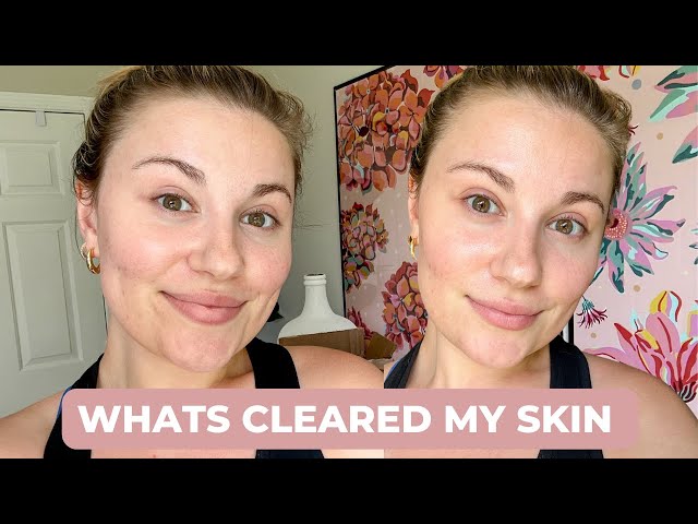 ACNE UPDATE | SUPPLEMENTS I'M TAKING TO CLEAR MY SKIN
