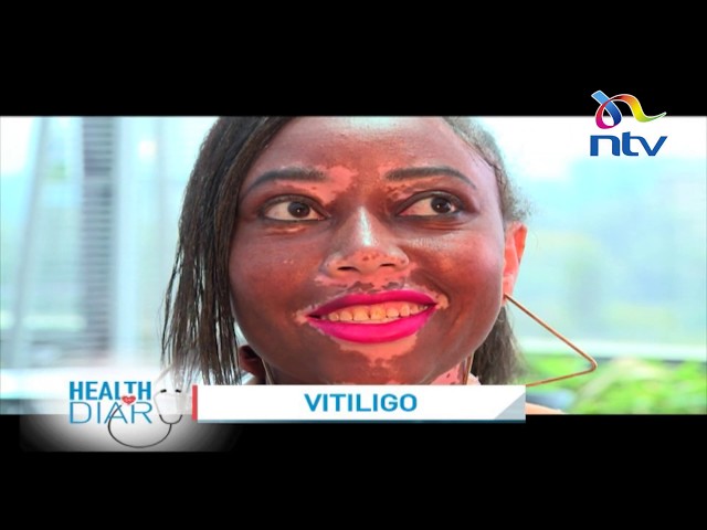 Understanding vitiligo and stigma victims undergo || Health Diary