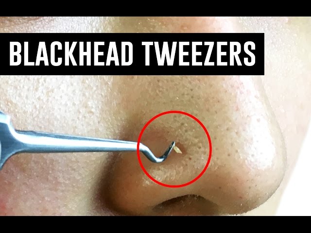 Tweezers That Remove Blackheads! TINA TRIES IT