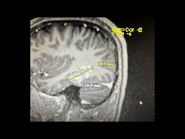 Laser ablation surgery helps treat young man's epilepsy.