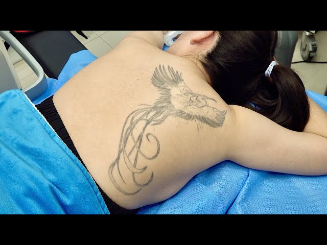 Process of Removing Bad Tattoo. Laser Tattoo Removal Korean Doctor