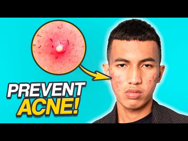 5 Easy Steps to Prevent Pimples | Men's Easy Skincare