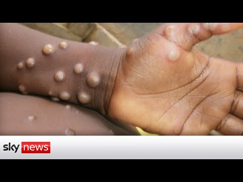 UK Monkeypox cases double to 20