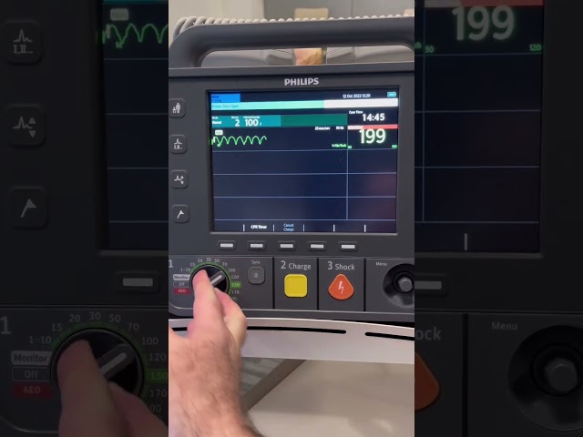 How to perform Synchronized Cardioversion using a Philips Intrepid Defibrillator