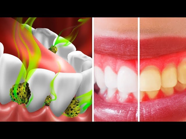 10 Möglichkeiten, Bakterien in Deinem Mund zu Töten und Mundgeruch zu Stoppen