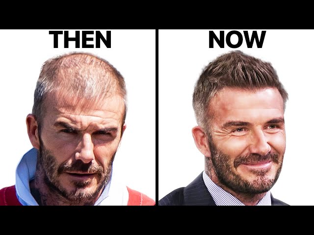 David Beckham: How He Stopped Hair Loss