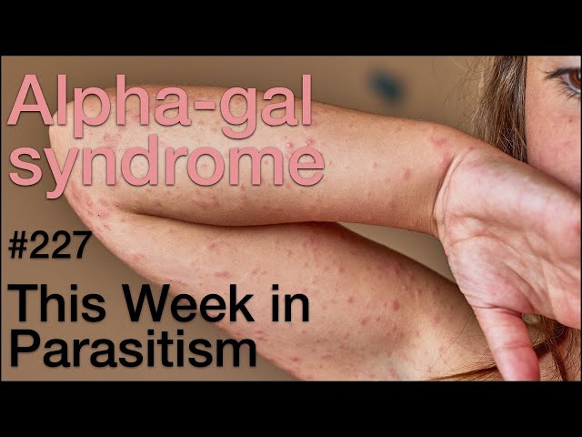 TWiP 227: Alpha-gal syndrome