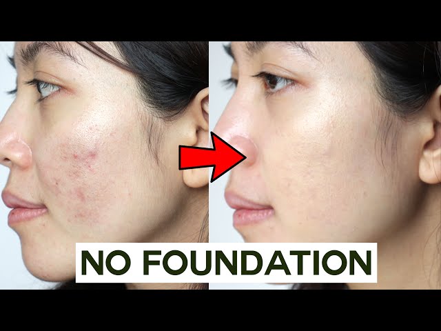How to Cover Acne & Blemishes WITHOUT Foundation  • easy & non cakey