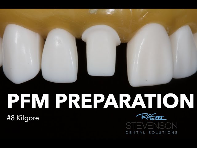 PFM Preparation for #8 Kilgore | Stevenson Dental Solutions