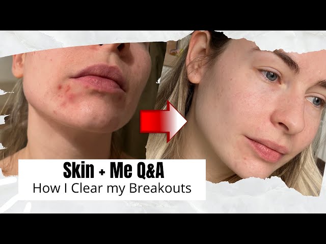 Answering your questions about Acne and Skin + Me | ad