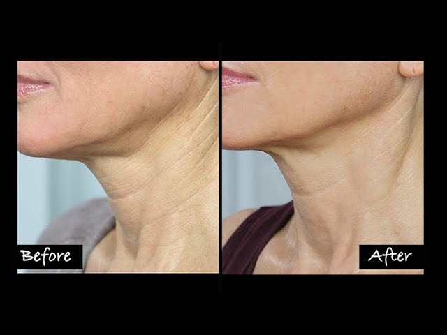 My Experience Getting Ultherapy | Non-Surgical Neck Lift? | Before & After