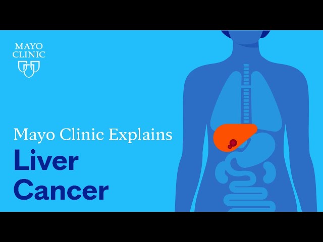 Mayo Clinic Explains Liver Cancer