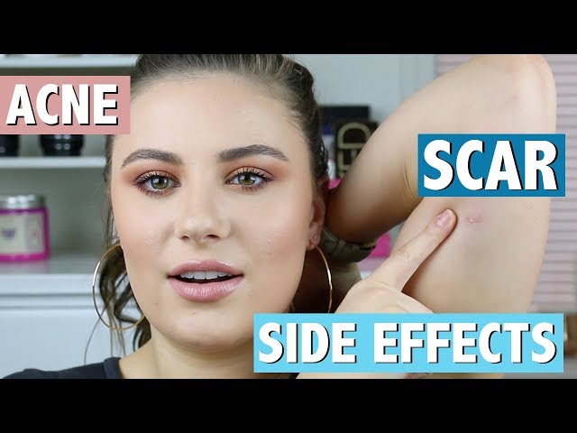 WHY I GOT N*XPLANON TAKEN OUT  |  SIDE EFFECTS & EXPERIENCE