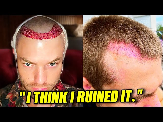 10 Things I Wish I Knew Before Getting a Hair Transplant
