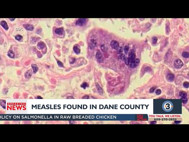 Measles case confirmed in Dane County