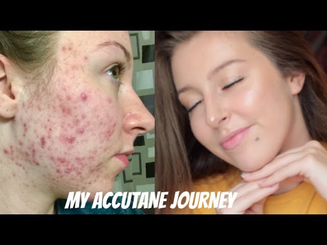 MY ISOTRETINOIN (ACCUTANE) JOURNEY + BEFORE AND AFTER PHOTOS