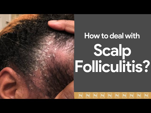 Dealing with Scalp Folliculitis? Watch immediately!