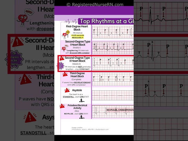 ECG (EKG) Rhythms to Know: Sinus Rhythms, Sinus Tachycardia, Heart blocks, etc.