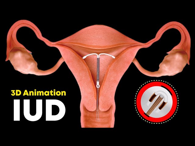 How IUD Is Inserted ? (3D Animation)