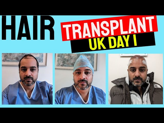 HAIR TRANSPLANT UK |  DAY 1 - PART 2 #hairtransformation #hairtransplant #fue #transplant