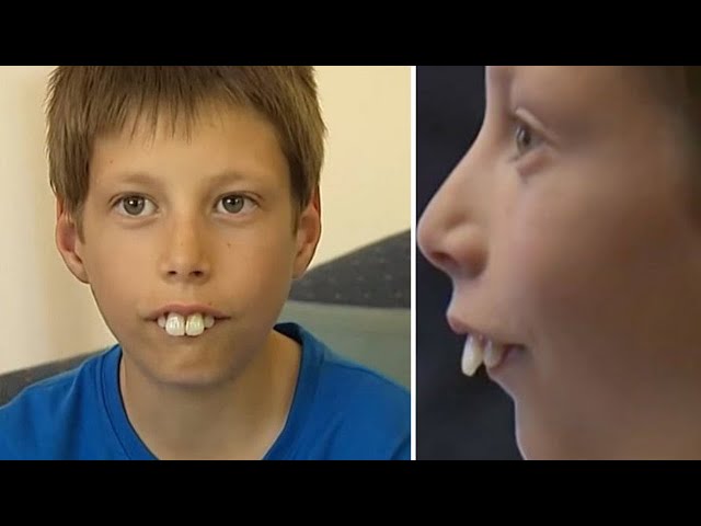 His classmates called him “rabbit boy” – now he has the perfect smile