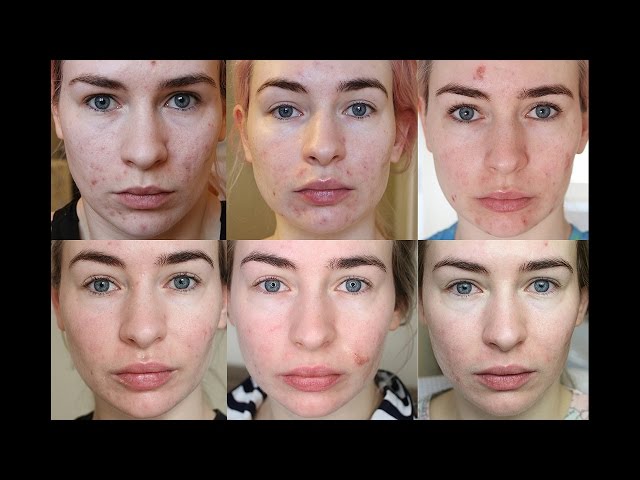 5 MONTH ROACCUTANE UPDATE - Side Effects & My Skin Now