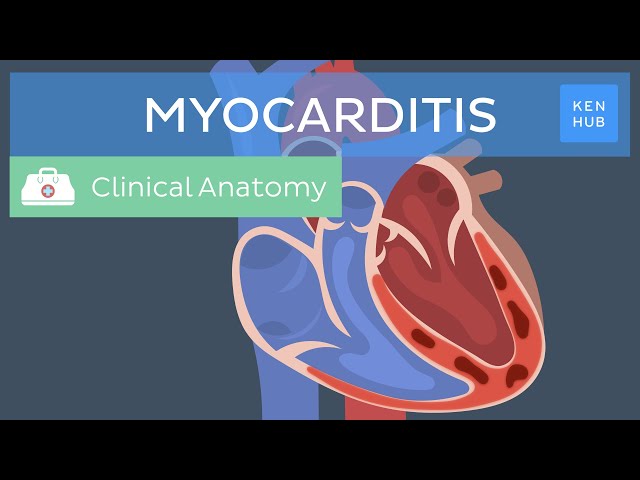 Myocarditis: Causes, symptoms, diagnosis, treatment and prognosis | Kenhub