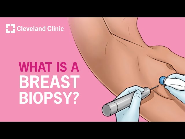 Breast Biopsy: Step-By-Step Explanation