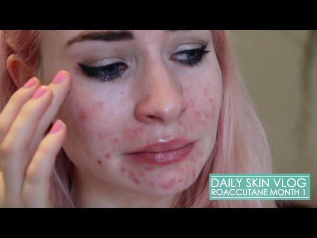 Roaccutane Daily Skin Vlog - Month 1