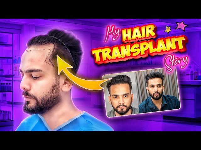 My Hairtransplant Journey - Elvish Yadav