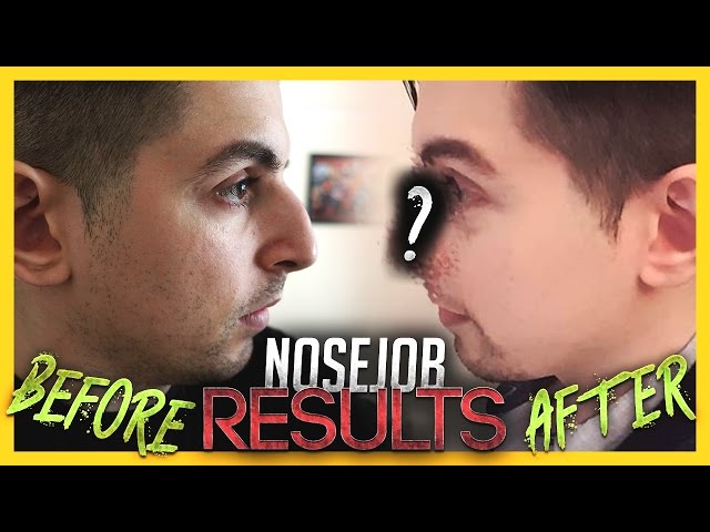 I Got a Nose Job! Before & After Results! | Gross Gore