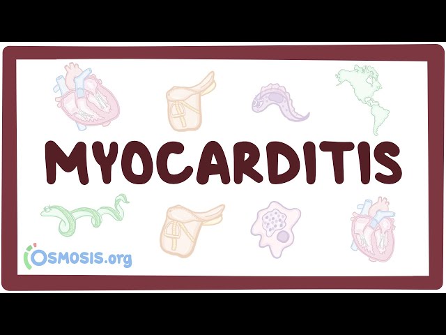Myocarditis  - causes, symptoms, diagnosis, treatment, pathology