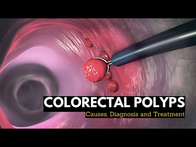 Colorectal Polyps, Causes, Signs and Symptoms, Diagnosis and Treatment.