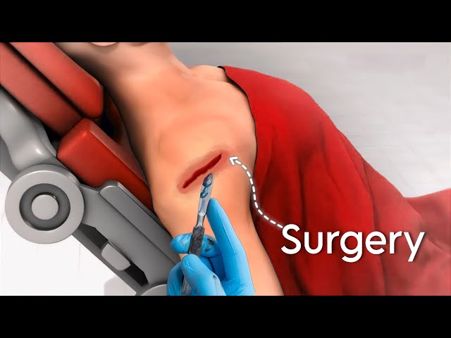 Rotator Cuff Repair ( Laproscopic Method ) Surgery : 3D Animation