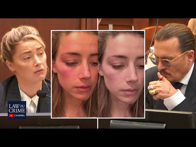 Johnny Depp's Lawyer Notes Differences in Injury Photos From Amber Heard