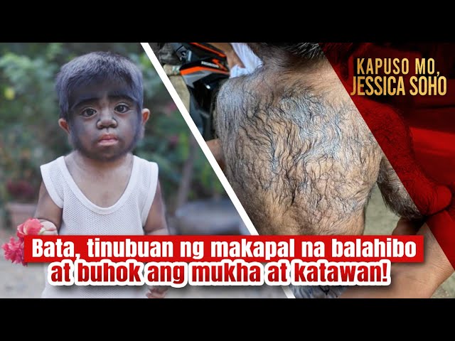 Bata, tinubuan ng makapal na balahibo at buhok ang mukha at katawan! | Kapuso Mo, Jessica Soho
