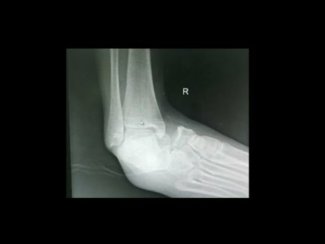 Orthopedic Case Discussion || Ankle Dislocation || Subtalar dislocation