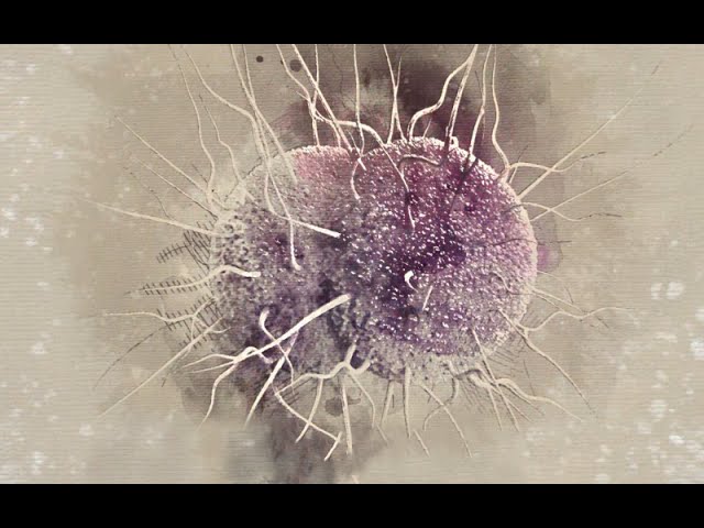 Drug-Resistant Gonorrhea: An Urgent Public Health Issue