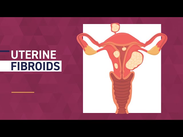 Fibroid Awareness Month | Common Fibroid Symptoms