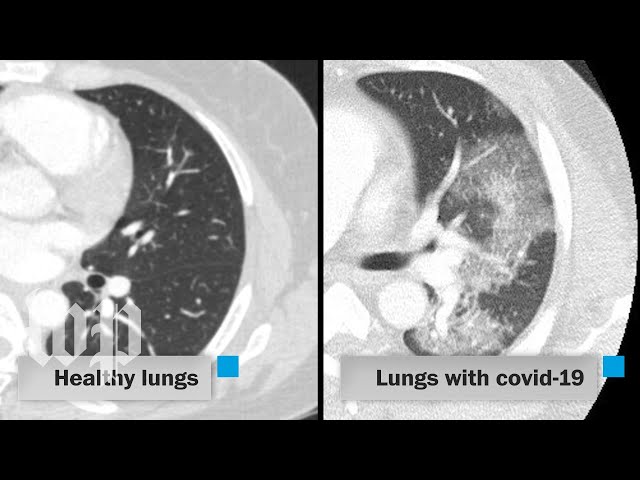How covid-19 attacks the lungs