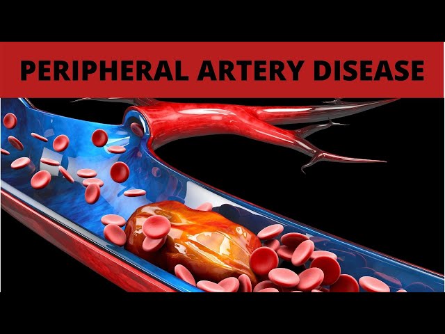 Treatment for Peripheral Artery Disease