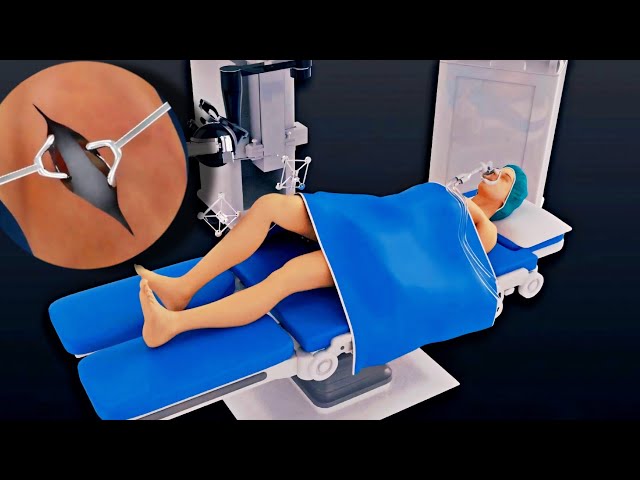 Revision Knee Surgery ( 3D Animation )