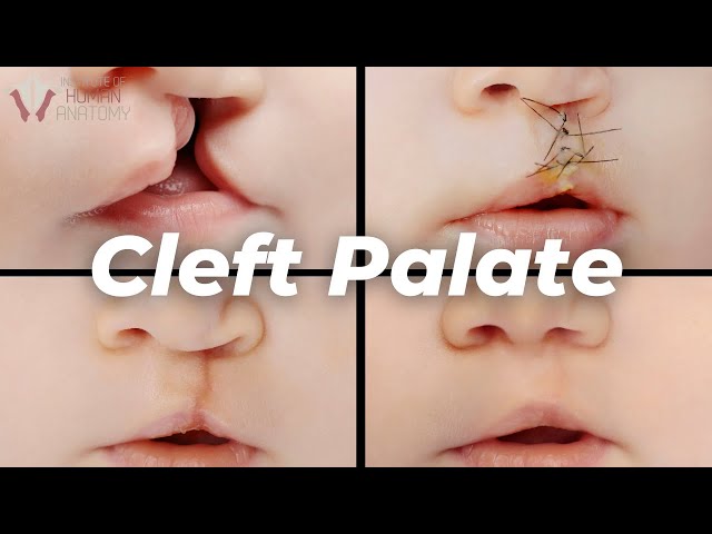 Why Cleft Palates Occur: A Scientific Explanation