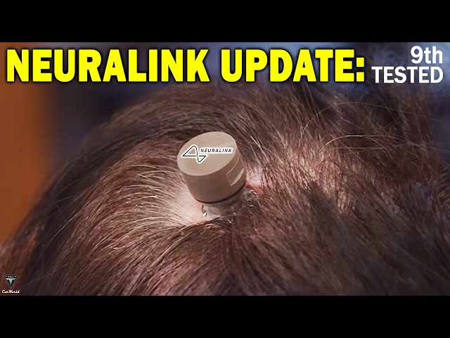IT HAPPENED! Elon Musk's Neuralink N1 Chip Tested 10 People on the NEXT Trials!