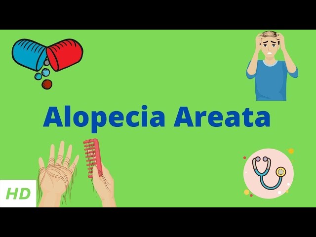 Alopecia Areata, Causes, SIgns and Symptoms, Diagnosis and Treatment.